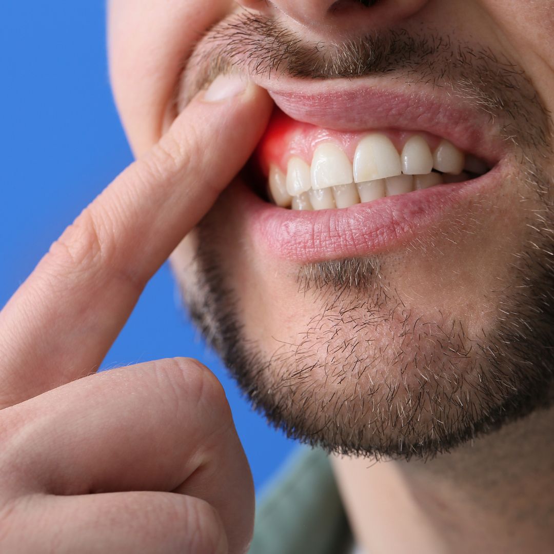 Man moving his upper lip with his pointer finger to expose his top gum. 