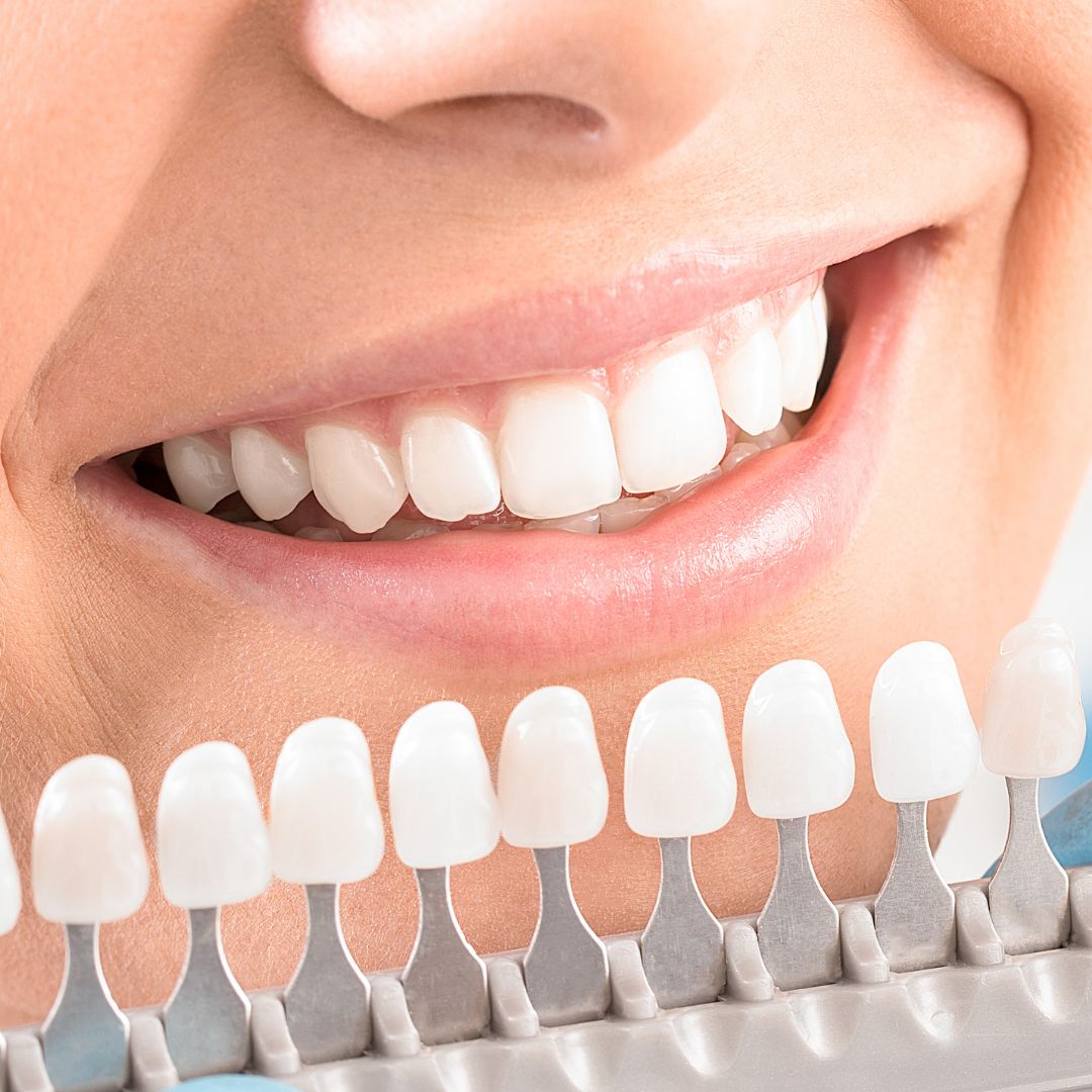 comparing shades of white for teeth whitening