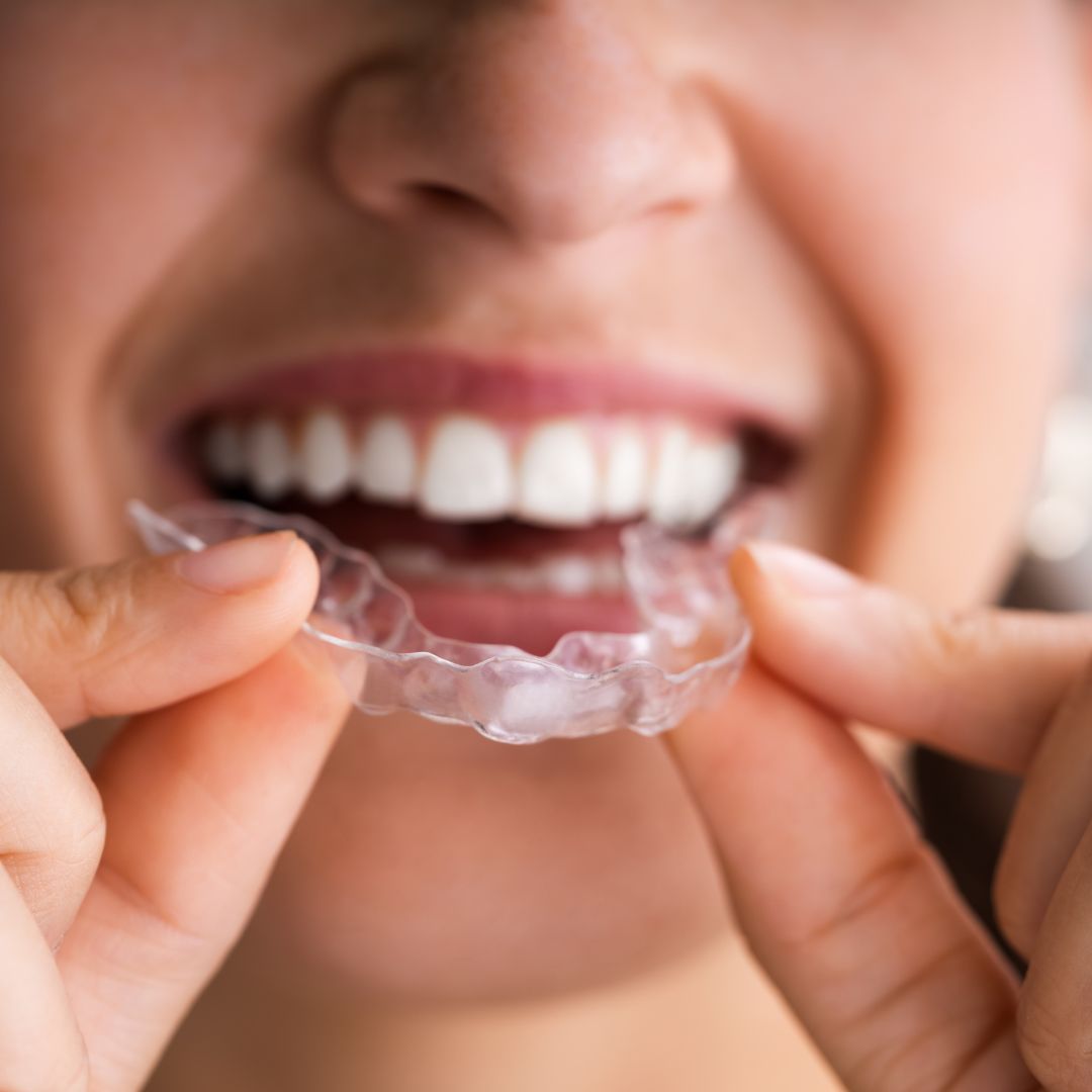 woman putting in a clear aligner