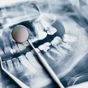 Dental tools placed on top of a dental x-ray